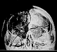 AP X-ray of Kennedy's skull