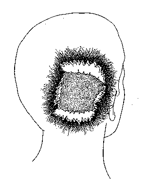 Drawing showing back of Kennedy's head blown out