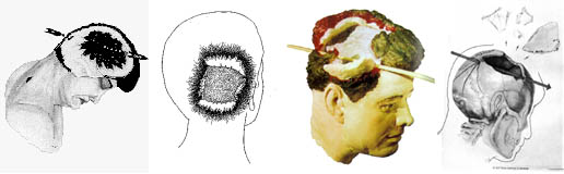 Various versions of Kennedy’s head wound