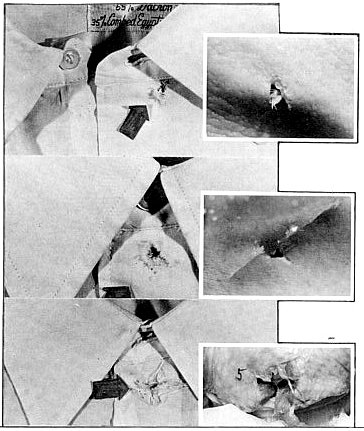 Lattimer's simulation of Kennedy's neck wound