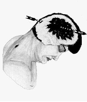 Warren Commission version of head wound
